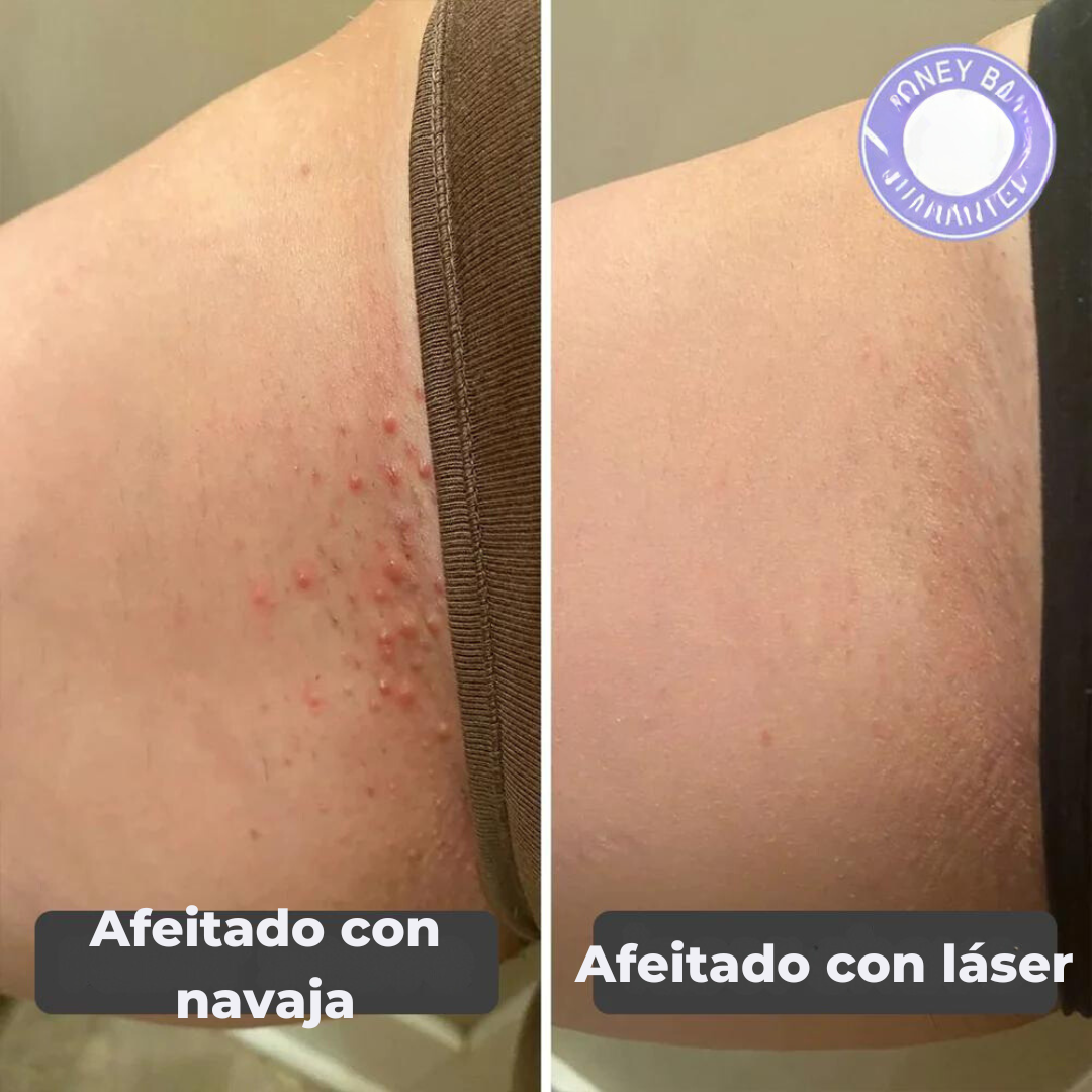 Depiladora 2 en 1™ Tecnología Laser + Regalo exclusivo 🎁