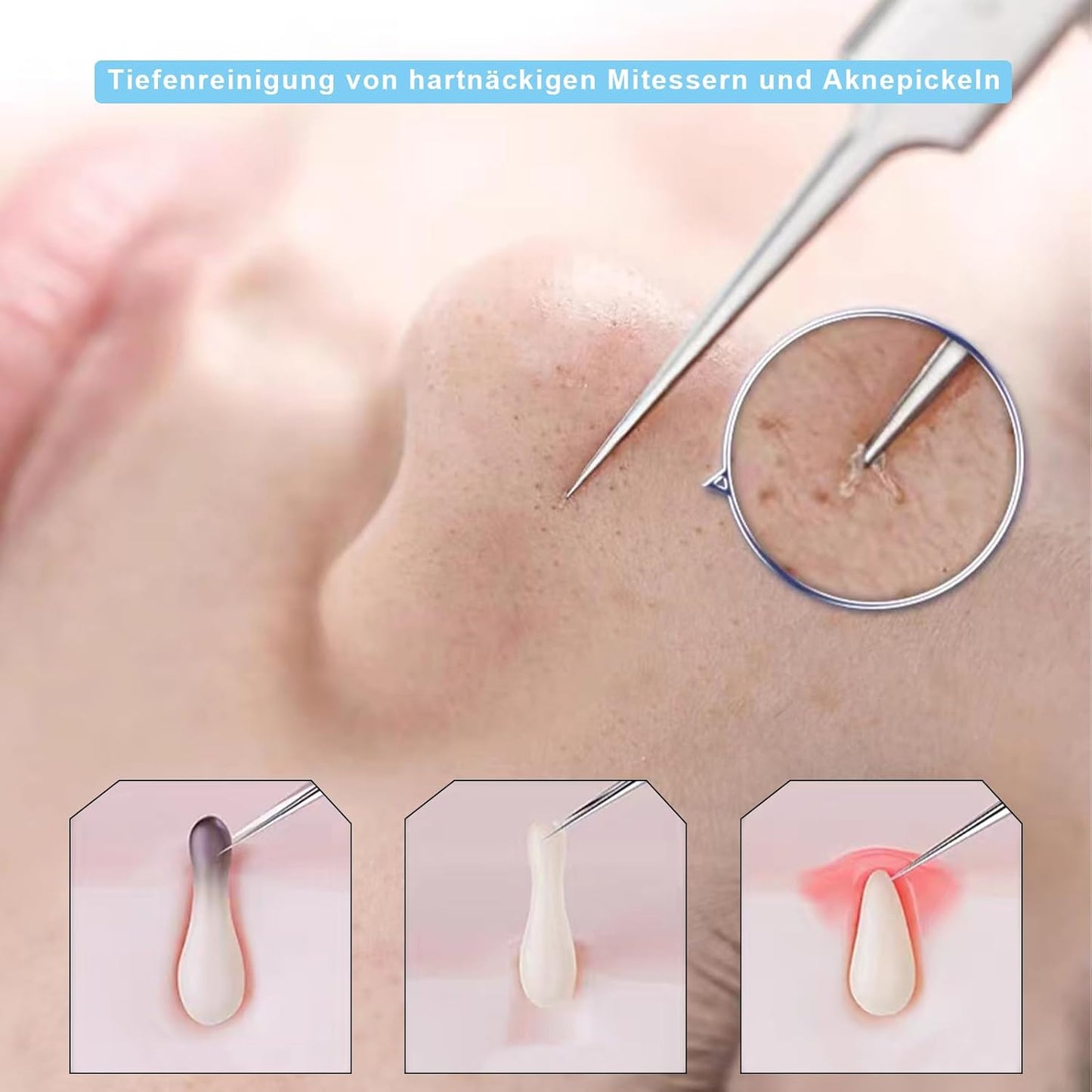 Kit de pinzas para puntos negros y espinillas ProSkin™